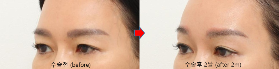 쌍꺼풀 수술 없이 쌍꺼풀이 다시 보이는 이유 관련 이미지 3