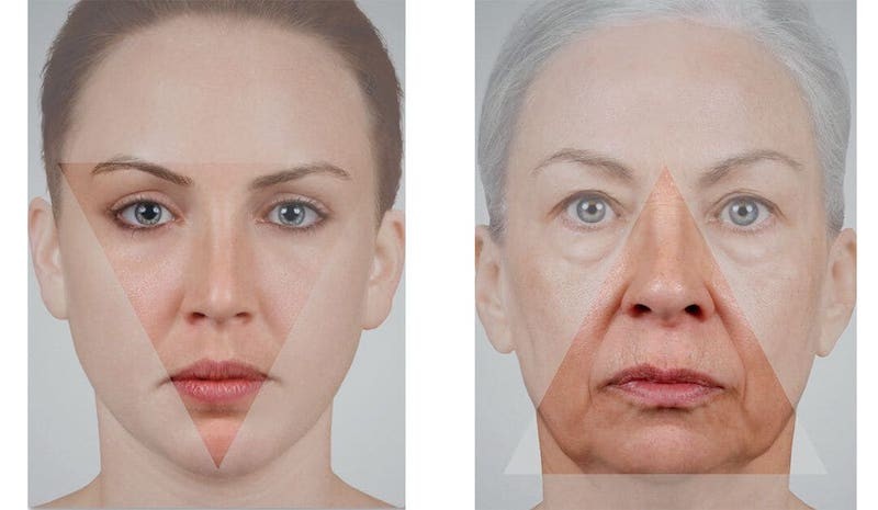 How a Facelift Changes Face Shape image 2