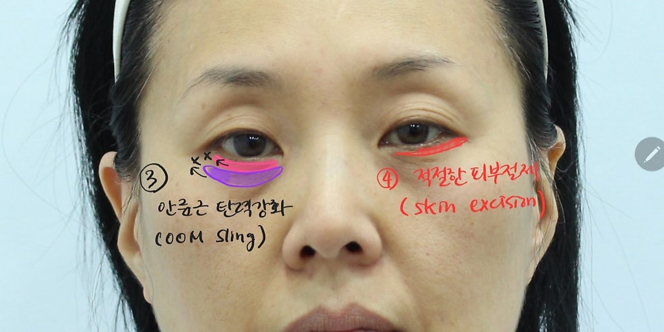 Lower Blepharoplasty in Your 50s to Add Firmness to the Midface image 4