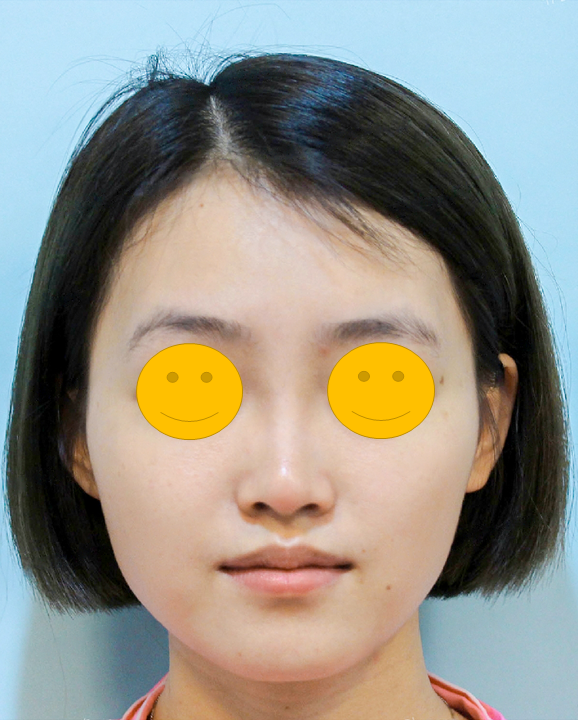 얼굴의 입체감을 살려주는 지방이식 관련 이미지 2