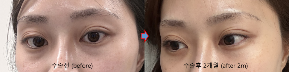 눈밑지방재배치, 복시&middot;사시는 걱정해야 할까요? (드문 부작용과 회복 과정) 관련 이미지 6
