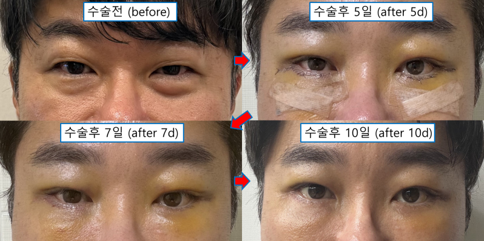 직장인 상하안검 수술, 연휴를 이용해 회복할 수 있을까? 관련 이미지 2