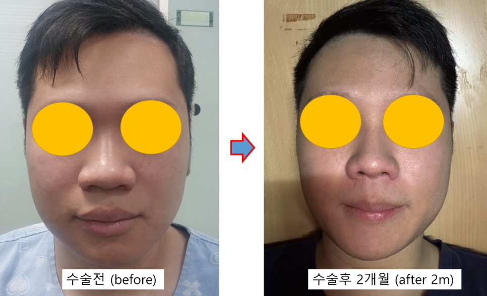 남자 복코 성형, 두꺼운 코끝을 자연스럽게 개선하기 관련 이미지 2