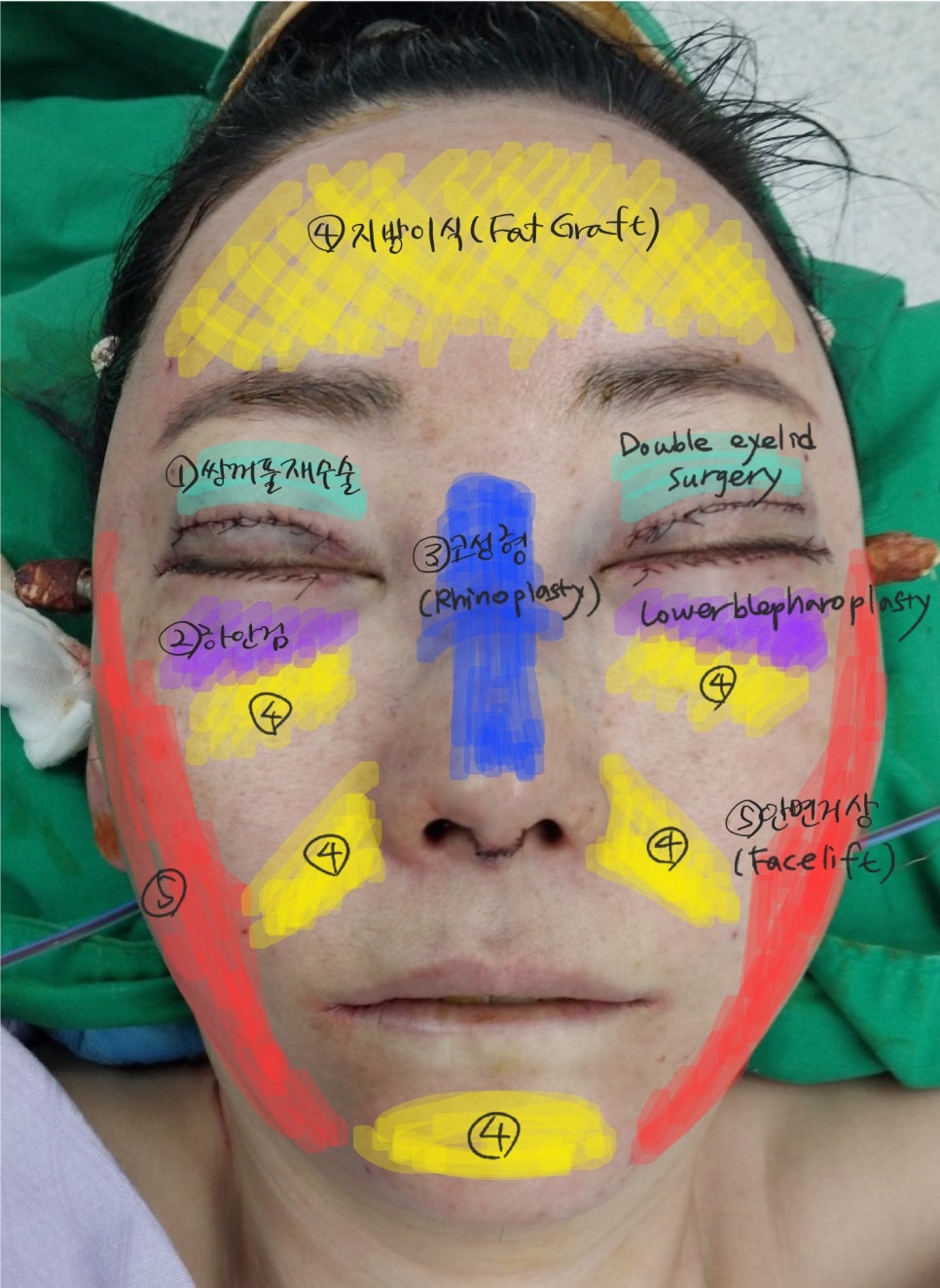 The Surgery Time and Recovery Period for Various Middle-Age Anti-Aging Surgeries image 4