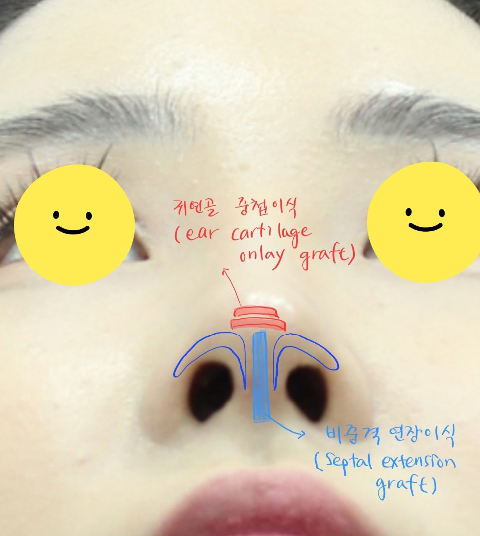 코성형에서 비중격 연골과 귀연골의 용도 관련 이미지 9