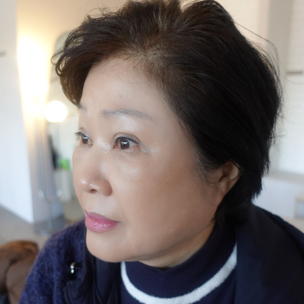 상안검 수술 후에도 눈이 불편하다면? &ndash; 눈 재수술과 이마거상을 함께 하는 이유 관련 이미지 6