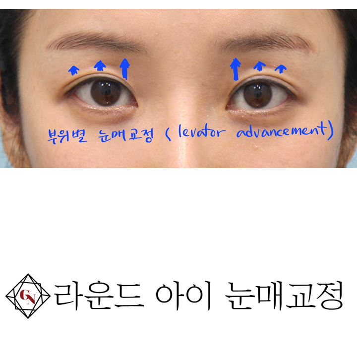 쌍꺼풀 수술과 함께 착한 이미지를 만드는 눈매교정 관련 이미지 9