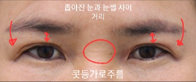 A Forehead Lift Is Essential When the Upper Eyelids Are Thick image 1