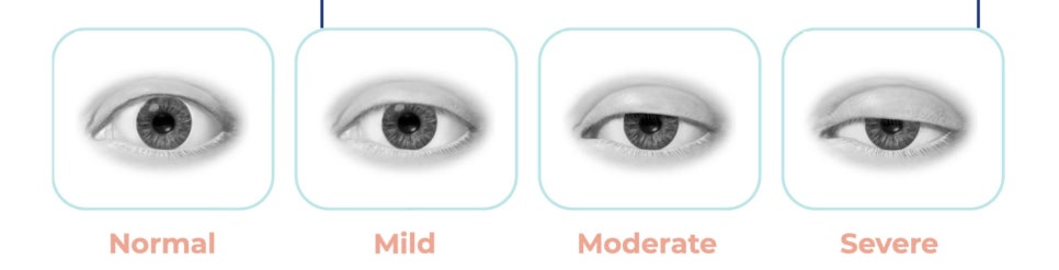 Double Eyelid Surgery and Ptosis Correction image 1
