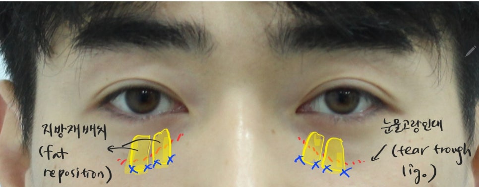 Types of Under-Eye Hollowness and Correction Methods image 4
