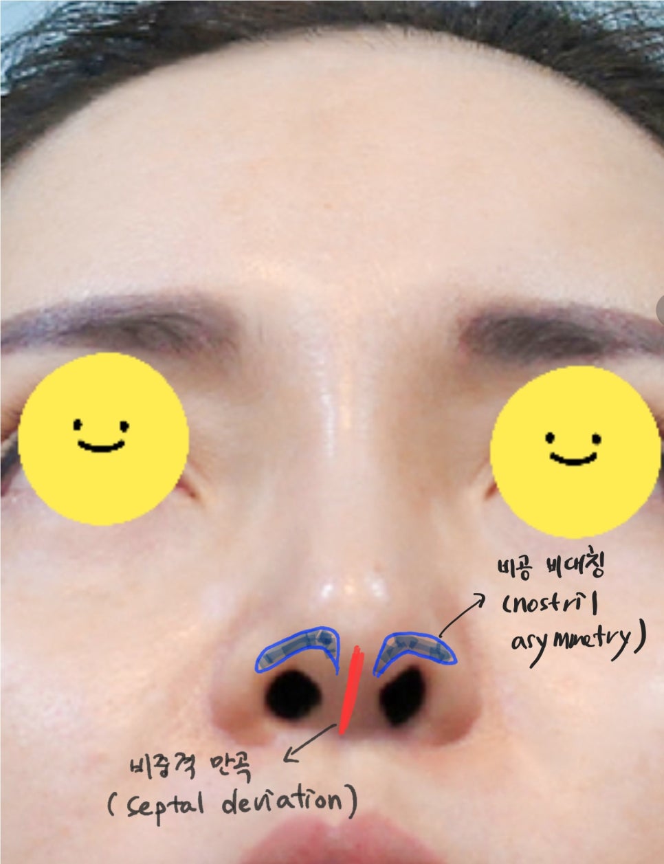 트렌드 변화에 따른 중년코 재수술 관련 이미지 2