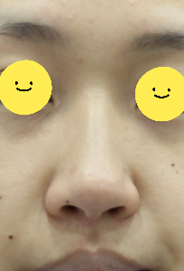 Two Methods of Nostril Reduction (Alar Reduction) image 1