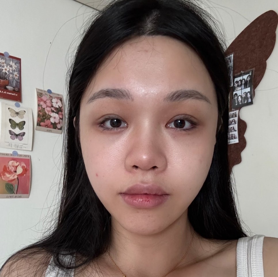 눈성형 종류 총정리, 어떤 수술부터 해야 할까요? 관련 이미지 6