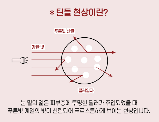 애교살 미세 지방이식의 자연스러움 관련 이미지 2