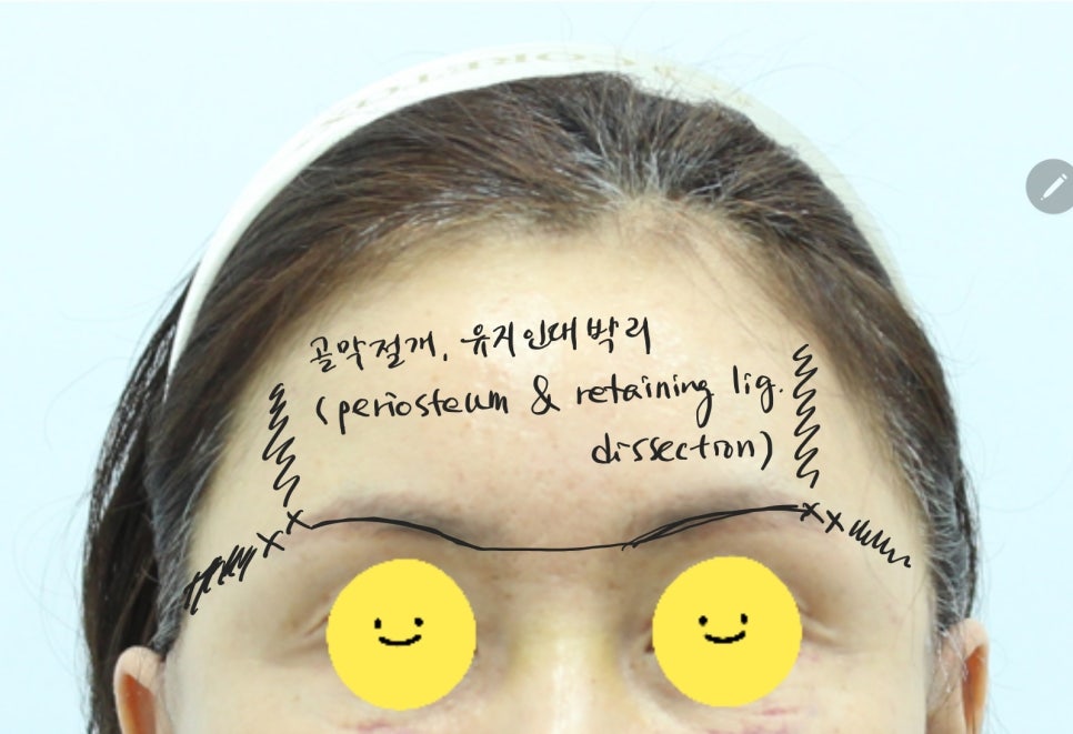 콧등주름과 미간주름의 리프팅 방법 관련 이미지 7