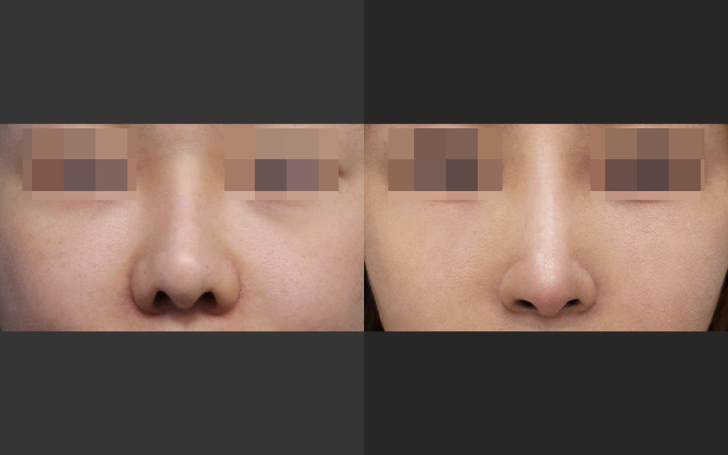 Lengthening Revision Rhinoplasty for a Short, Upturned Nose image 6