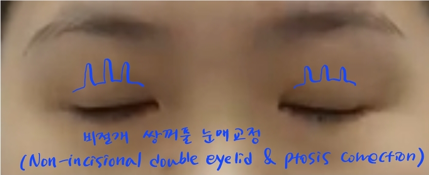 비절개 눈매교정으로 짝눈 교정이 가능한 경우 관련 이미지 4