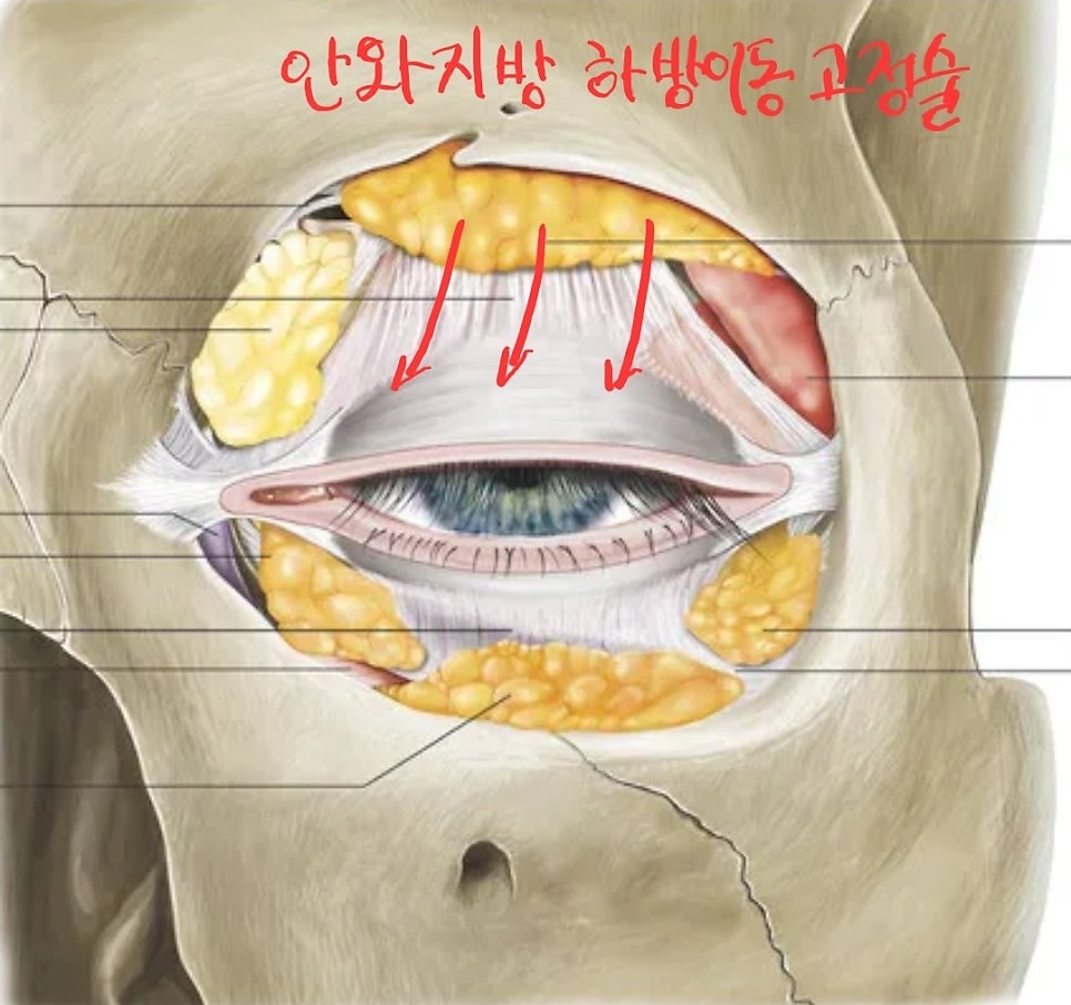 쌍꺼풀 수술에서 겹주름과 꺼진 눈 교정 관련 이미지 4