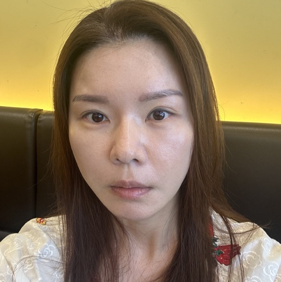40대 후반 눈밑성형, 꼭 하안검일까? 눈밑지방재배치로 해결한 이유 관련 이미지 5