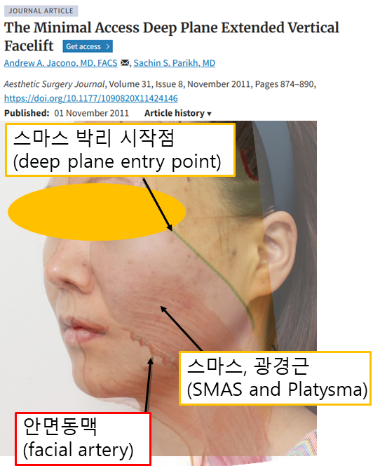 미니거상의 진화, MACS에서 딥미니거상(MADE)까지 관련 이미지 2