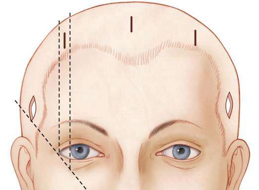 A Forehead Lift Is Essential When the Upper Eyelids Are Thick image 2