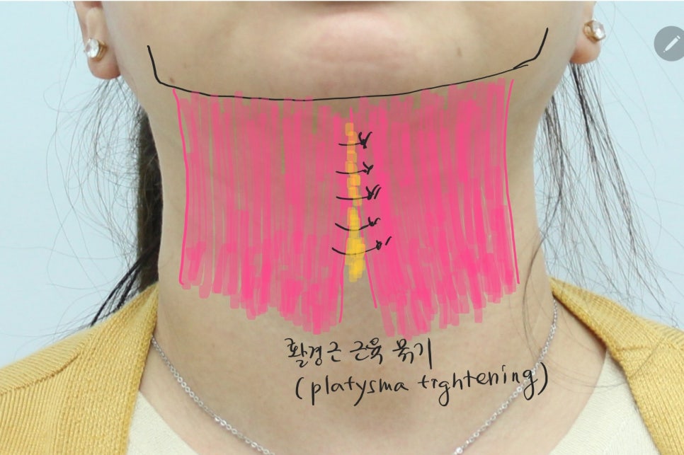 Submental Incision Neck Lift Performed Together with Facelift image 7