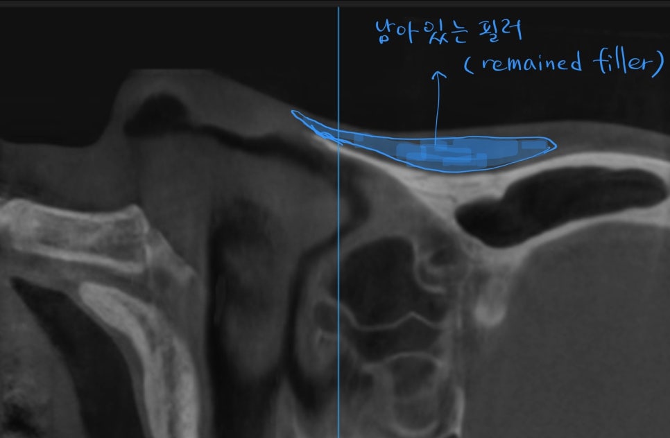 오래된 코필러를 녹이면서 시행하는 코성형 관련 이미지 2