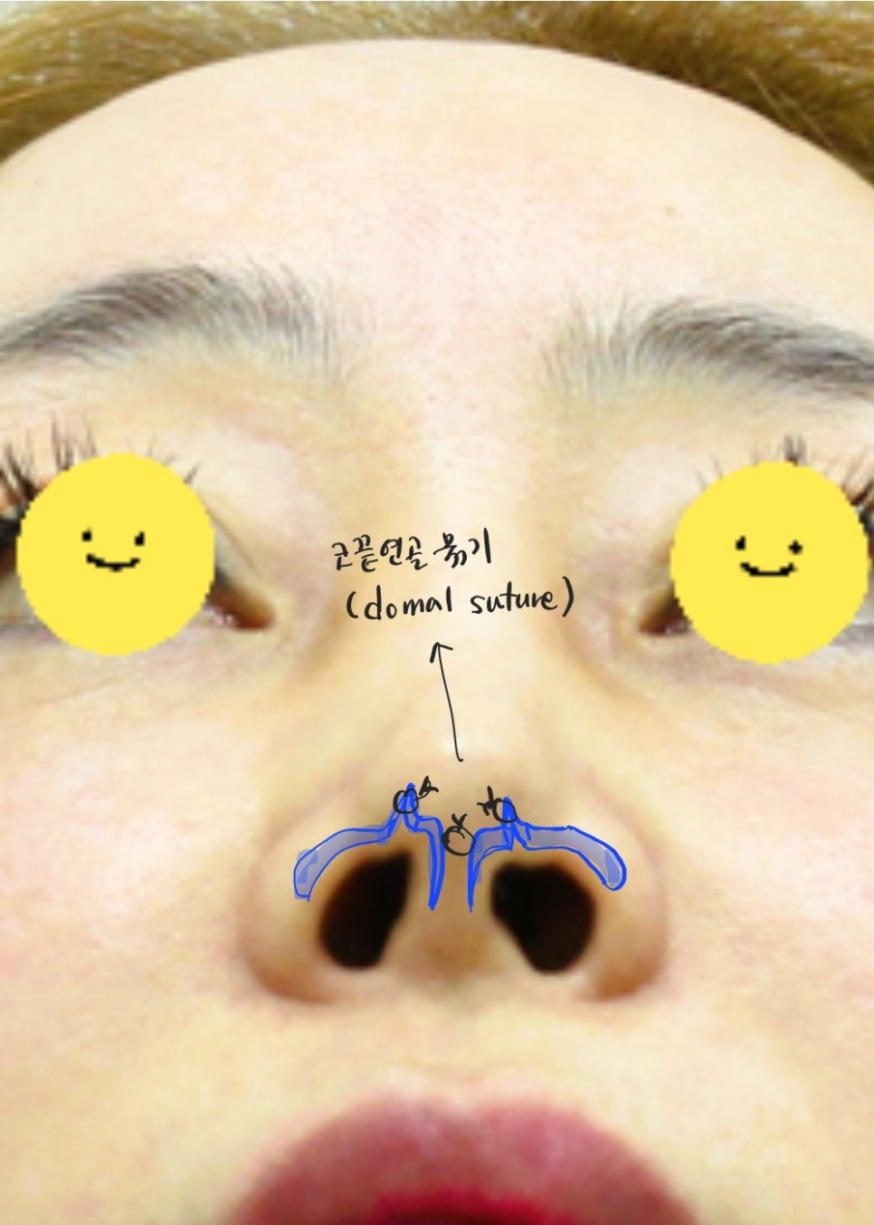 Correction of a Pinched Nose or Indented Nose image 5