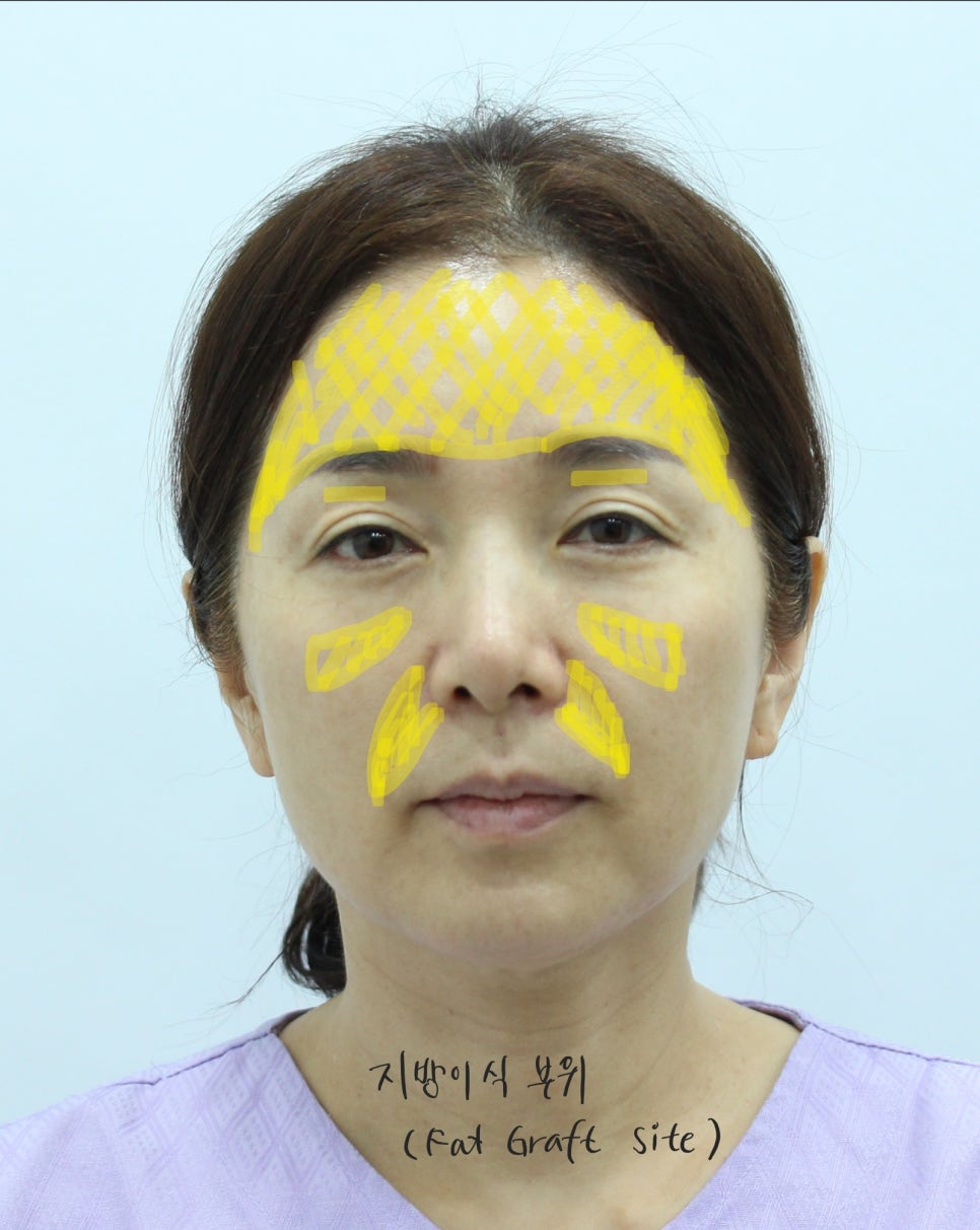얼굴의 지방층 변화와 중년지방이식 관련 이미지 10