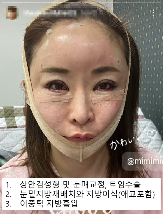 Key Points of Eye Surgery for People in Their 40s and 50s, Seen Through Ahn Seon-young’s Eye Surgery image 5