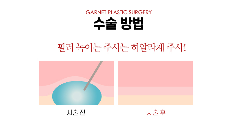 【가넷성형외과 백인수원장 성형칼럼】 코필러제거 후 코수술 케이스 관련 이미지 4