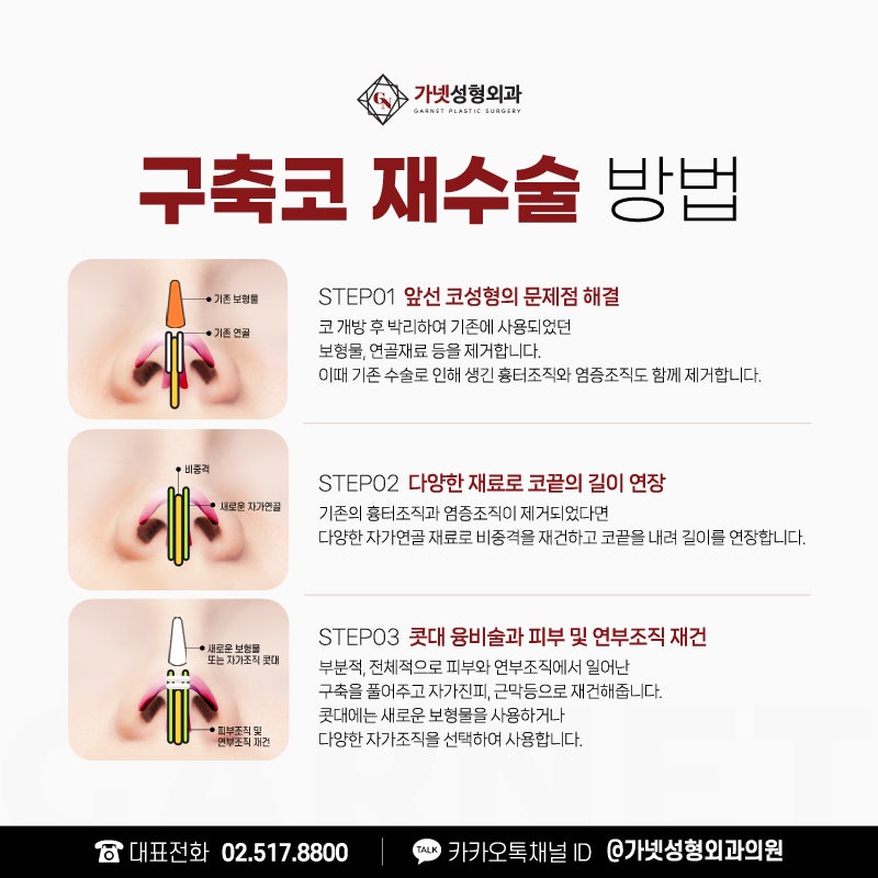 구축코재수술, 더 이상의 부작용을 피하고 싶다면? 관련 이미지 4