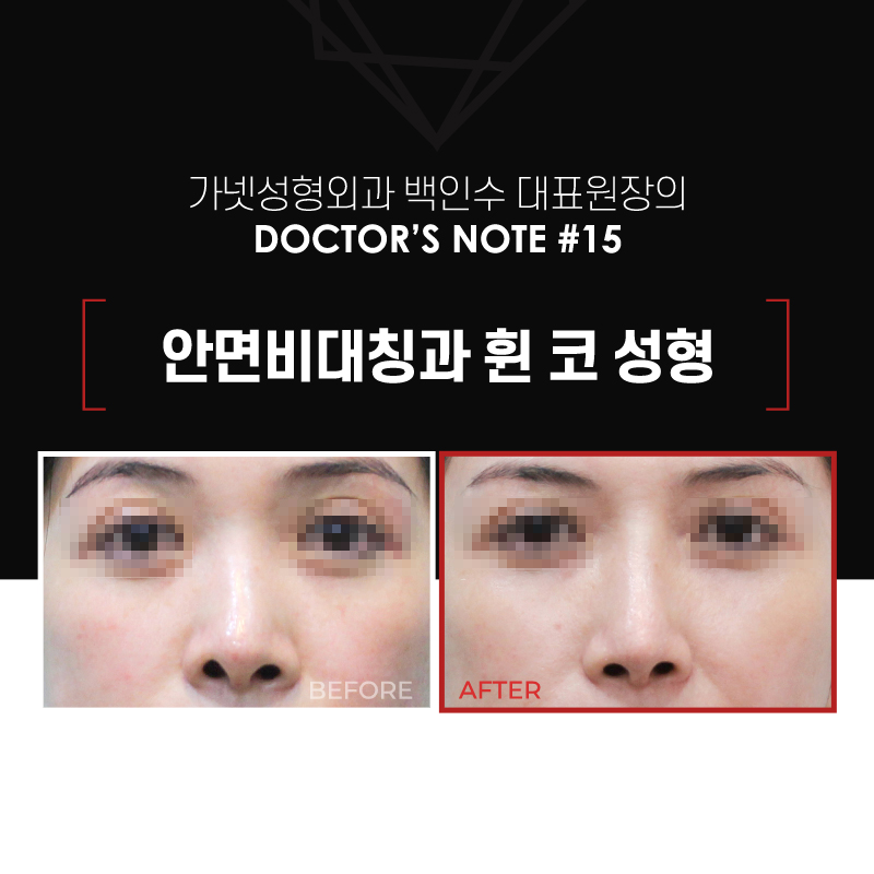 【Garnet Plastic Surgery Director Baek In-soo’s Plastic Surgery Column】 Facial Asymmetry and Crooked Nose Surgery image 2