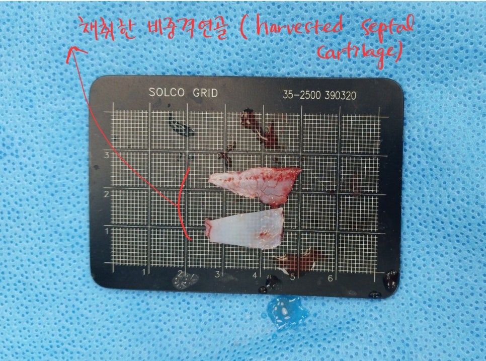 자연스러운 변화를 위한 무보형물 코성형 관련 이미지 3