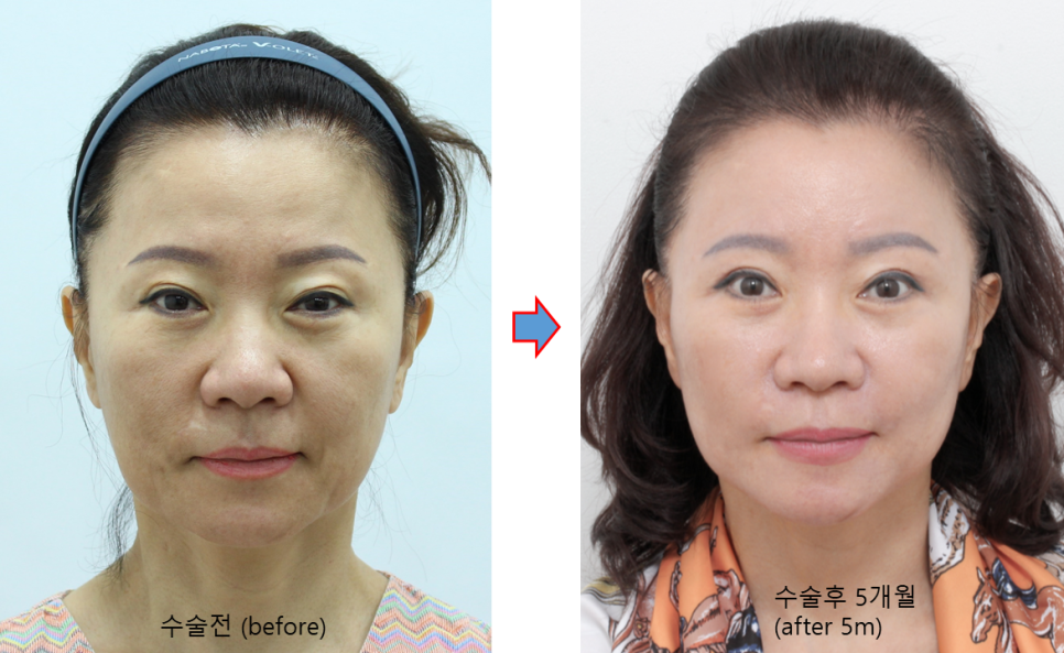 After a Face Lift, When Will Swelling and Bruising Go Away? Recovery Process and Natural Results image 5