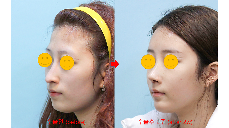 중안면이 긴 얼굴의 코성형과 지방이식 관련 이미지 8