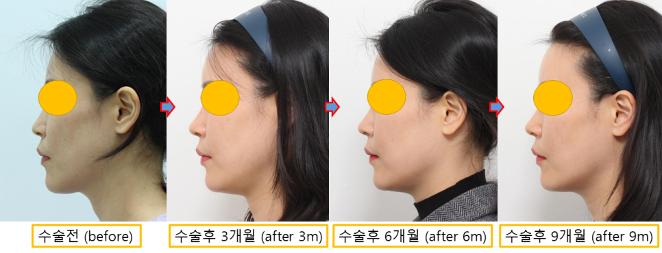 얼굴 지방이식 유지기간, 3·6·9개월 경과로 알아보는 생착과정 관련 이미지 8