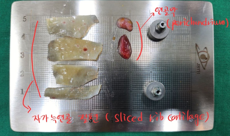 Rib Cartilage Nose Revision Surgery for Bird Beak Deformity image 6
