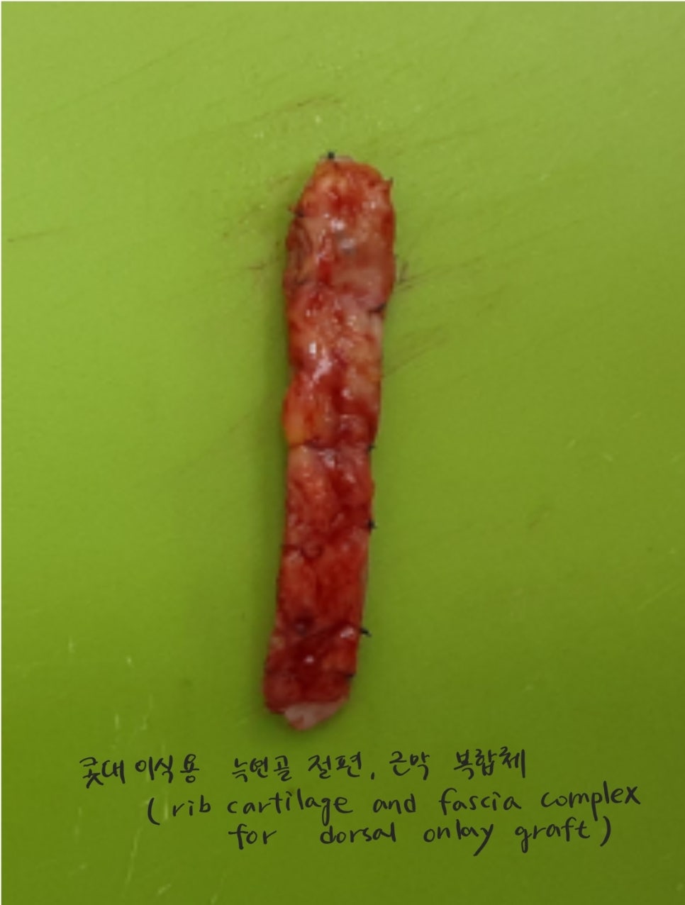 콧대에 실리콘 보형물을 늑연골로 대체하는 경우 관련 이미지 5