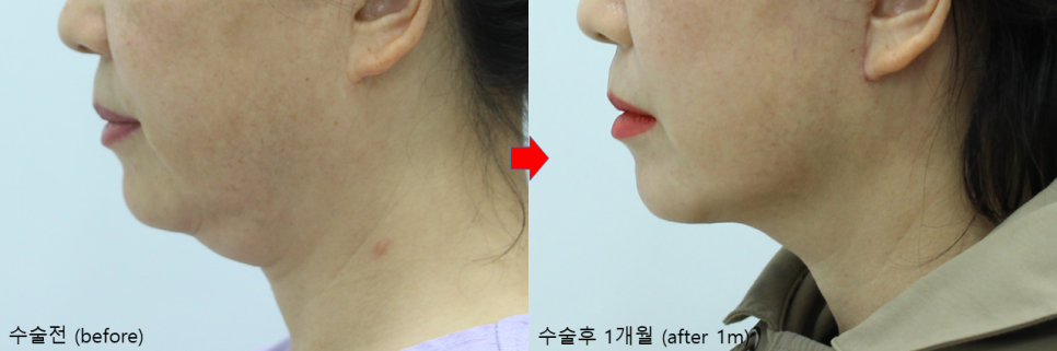 안면거상과 함께하는 목거상술 관련 이미지 6