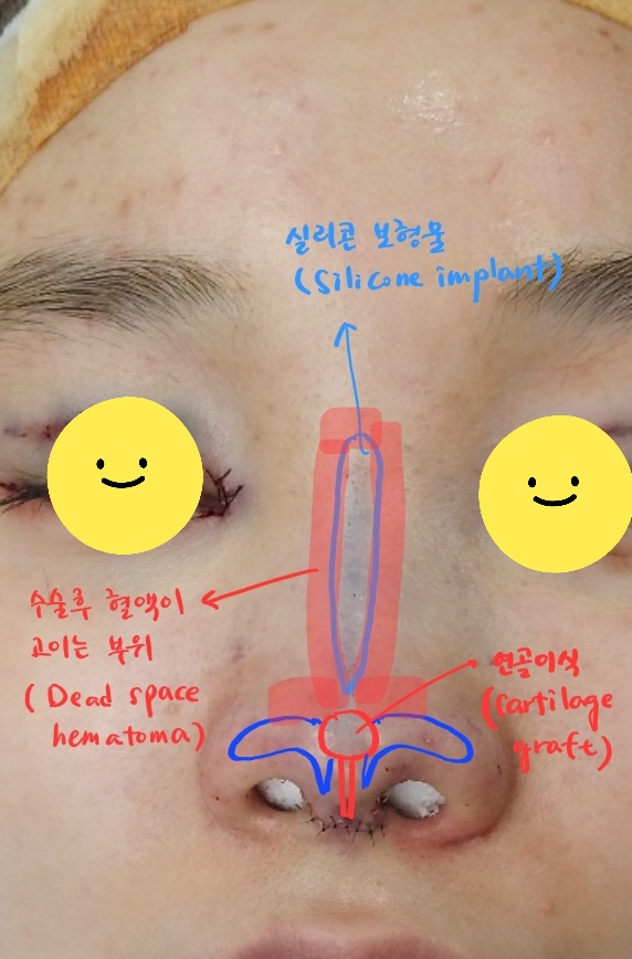 Treatment Process to Speed Recovery After Rhinoplasty image 2