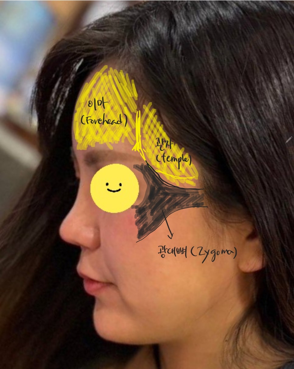 Forehead Fat Grafting for a More Youthful Face image 5