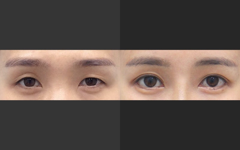 쌍꺼풀 수술에서 겹주름과 꺼진 눈 교정 관련 이미지 5