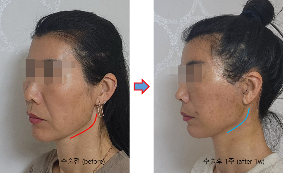 How a Facelift Changes Face Shape image 4