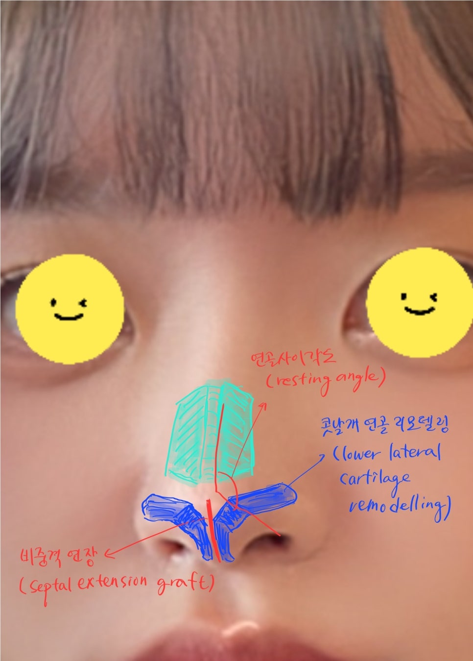 Nasal Tip Remodeling for Bulbous Nose and Drooping Columella Correction image 4