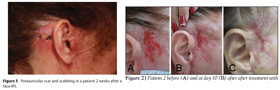 Hyperbaric Oxygen Therapy for Faster Recovery After Plastic Surgery image 6