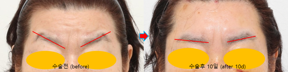 이마거상으로 화난 눈썹을 교정할 수 있을까요? 관련 이미지 4
