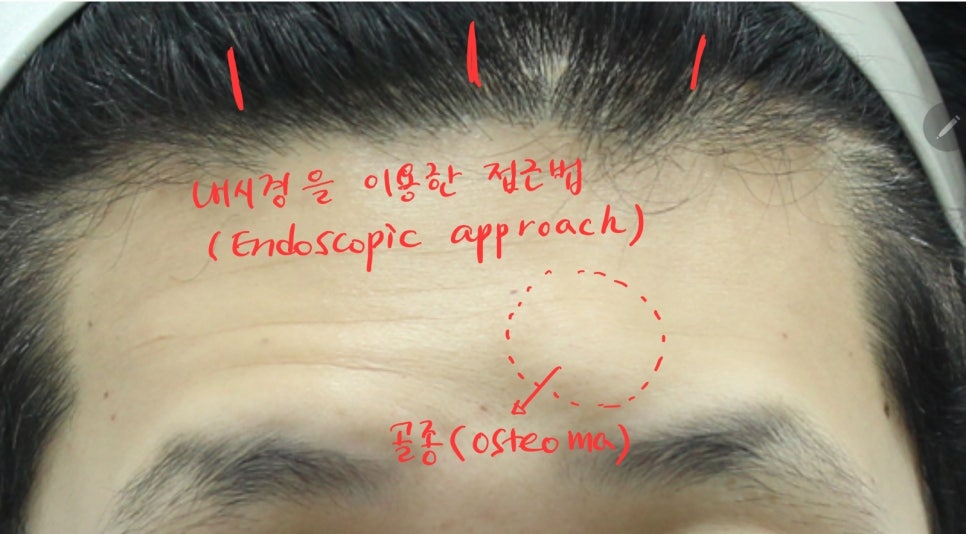 내시경 이마거상과 함께 시행한 골종제거 관련 이미지 6