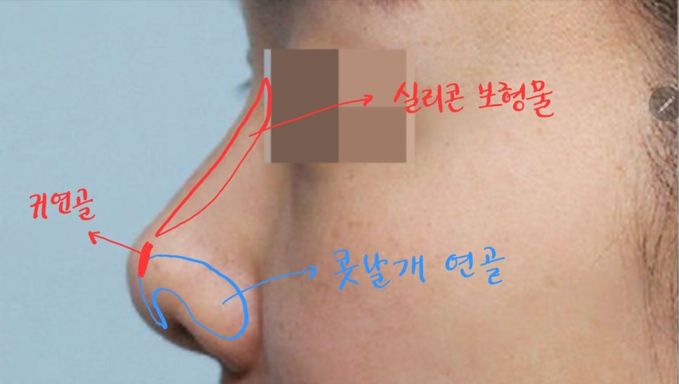 Lengthening Revision Rhinoplasty for a Short, Upturned Nose image 2