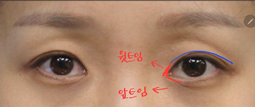 Two-Way Epicanthoplasty for a Cool Semi-Outlook Line image 4